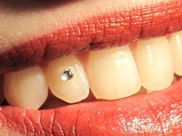 estetica dentara bijuterii in dinti